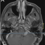Cerebellar liponeurocytoma: illustrative case